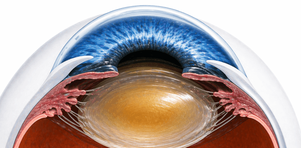 cataract eye image