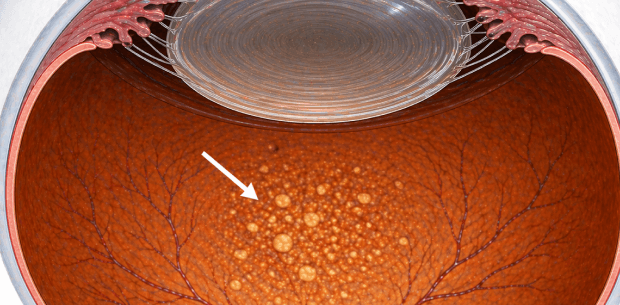 cataract eye image