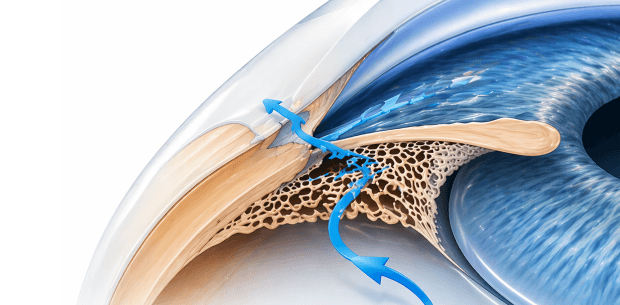 cataract eye image